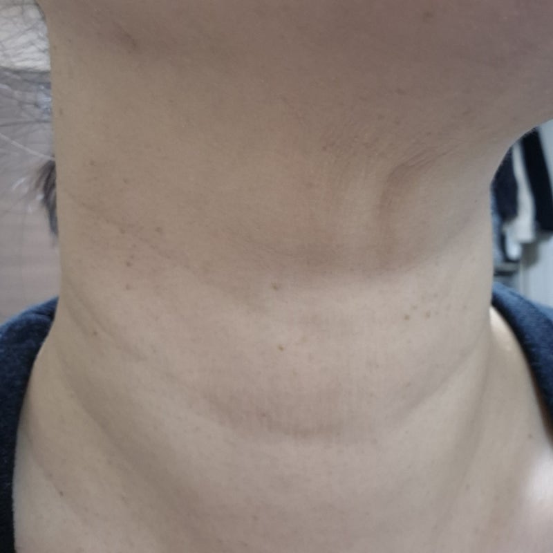 대구사마귀성지 대구편평사마귀제거·대구쥐젖제거 고민 끝｜대구편평사마귀무제한으로 한....