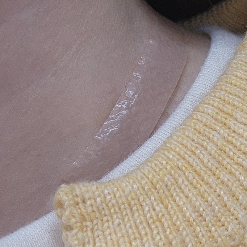 [갑상선암 투병 일지] #15 수술 흉터 변화 기록