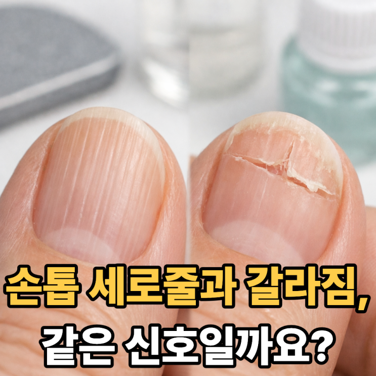  손톱 세로줄과 갈라짐, 같은 문제일까?｜헷갈리는 손톱 변화 정리