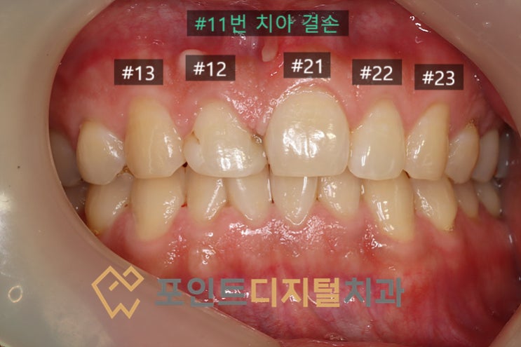  [탕정역치과]  심미보철 선천적 결손 치아 재치료 케이스(크라운) / 천안 아산
