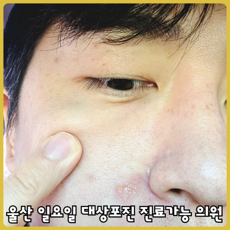 울산 일요일 대상포진 진료 가능 내과 : 이영암 내과의원