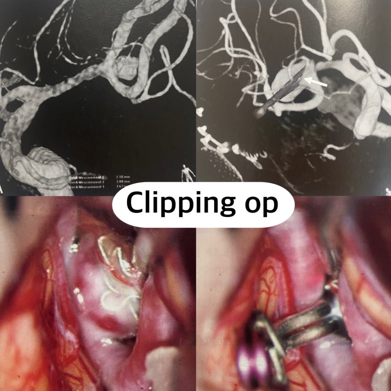 뇌동맥류 클립결찰술 Clipping OP (Aneurysm Clipping Operation) 원리, 치료방법