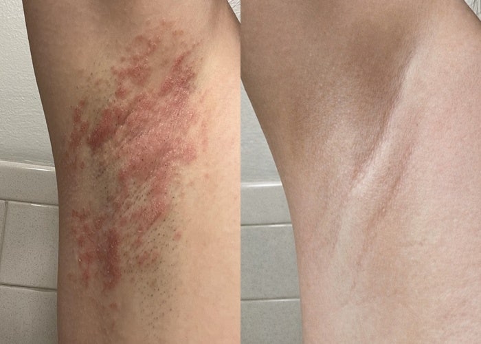 겨드랑이 가려움 습진 발진 원인 곰팡이균 관리후