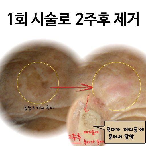  포항 흑자 치료, 방문 전 2가지만 확인하세요