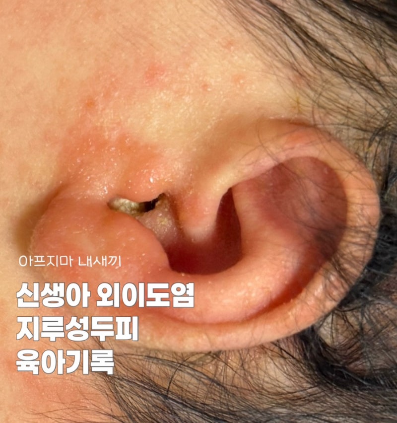 신생아 외이도염,지루성두피염 기록