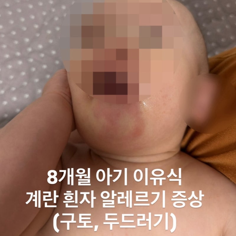 8개월 아기 이유식 계란 흰자 알레르기 증상 | 구토, 두드러기