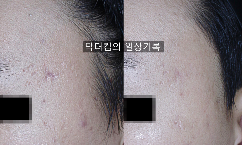 얼굴 여드름 흉터 제거, 다양한 레이저 치료 및 관리 방법  [by 피부과 전문의 닥터킴]
