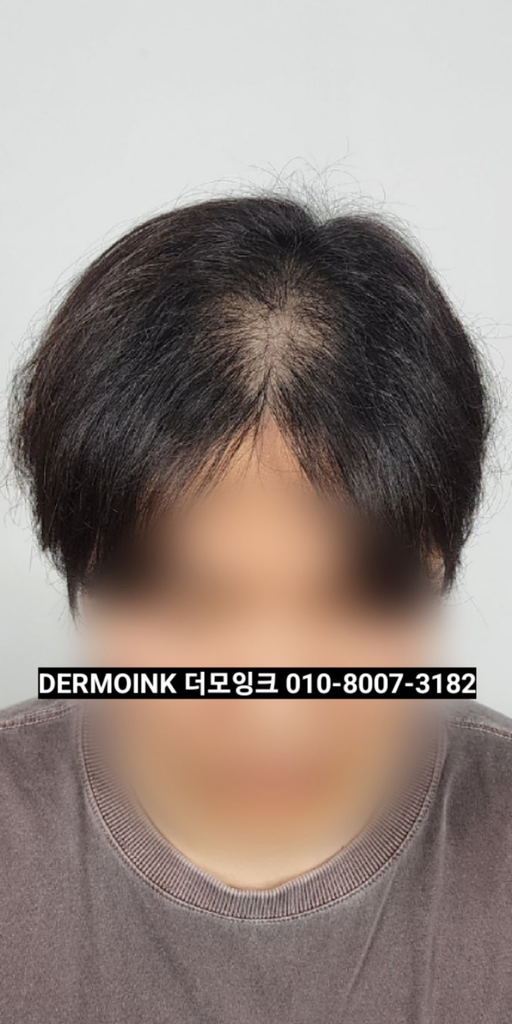  수원 영통 남자 두피 커버, 정수리 가르마 탈모 고민 자연스럽게 이미지 변신 후기