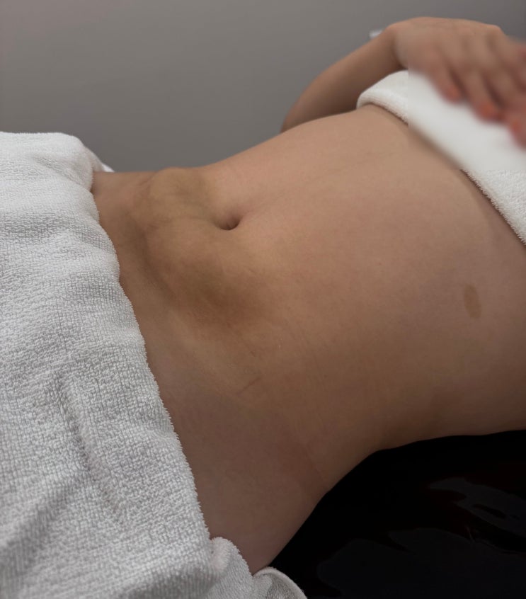 복부 지방흡입 후관리 언제부터 왜 필요할까요? 관리 전후 차이