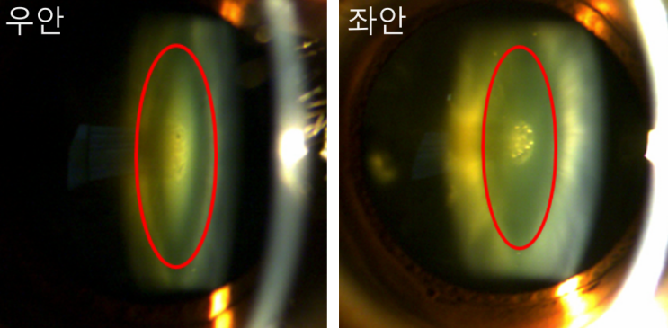  노안인데 근시도 심해졌다? — 핵백내장을 의심하세요