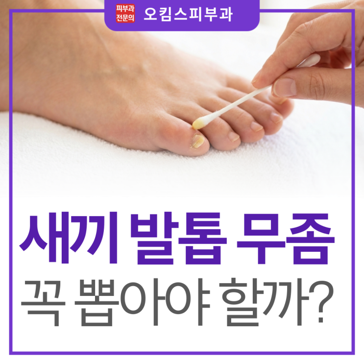  일산 무좀 피부과 새끼 발톱 무좀 생기면 무조건 뽑아야 할까?