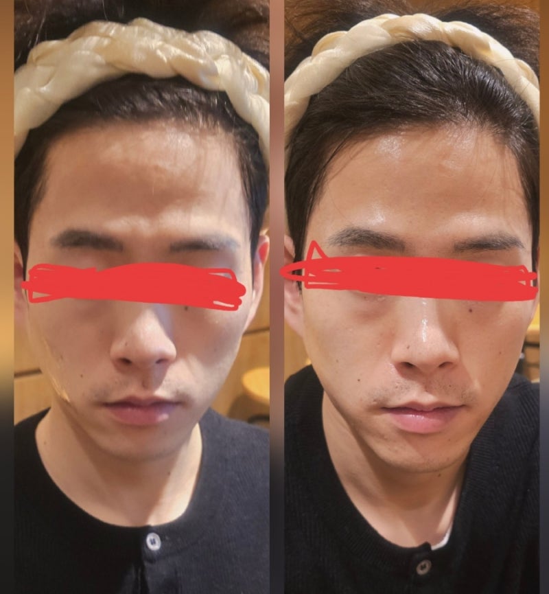 암웨이 더마아키텍트 사용 전·후 리얼 후기