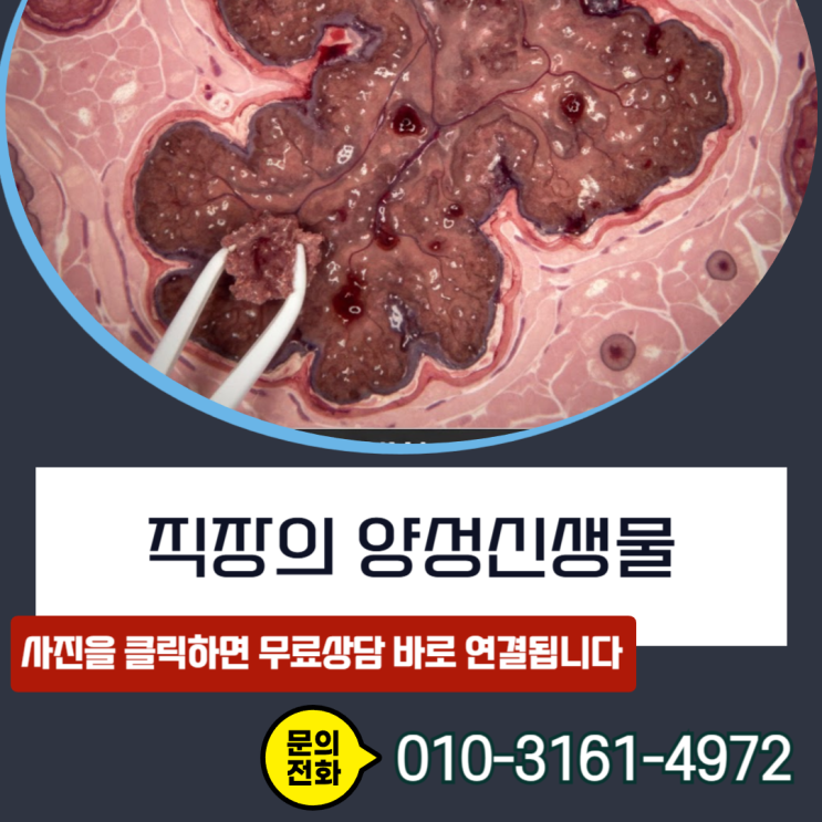  직장의 양성신생물 암진단비D12.8 코드, 제자리암 보상 가능한 이유