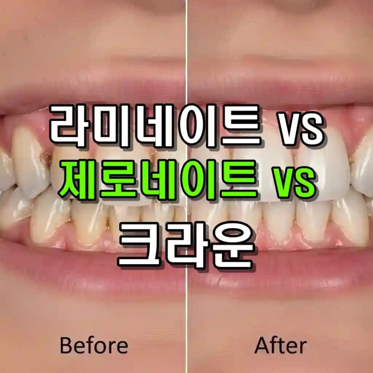  라미네이트 vs 제로네이트 vs 크라운, 망하지 않으려면