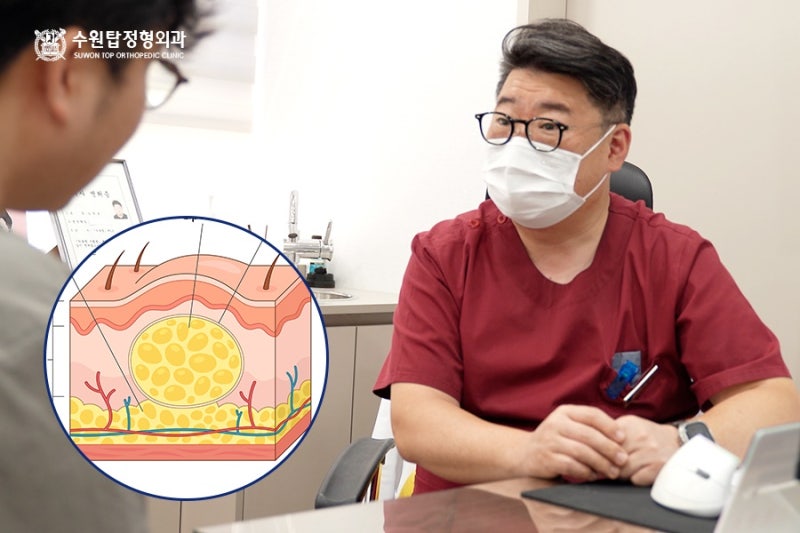 수원 지방종 제거 병원, 혹이 커지기 전에 확인해야 할 점