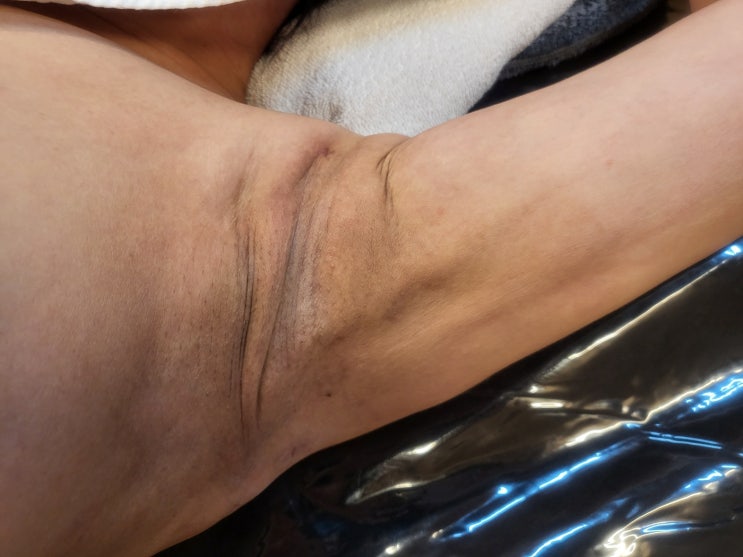  팔뚝 지흡 바본, 왜 생기고 언제 풀릴까요? (비포,애프터)