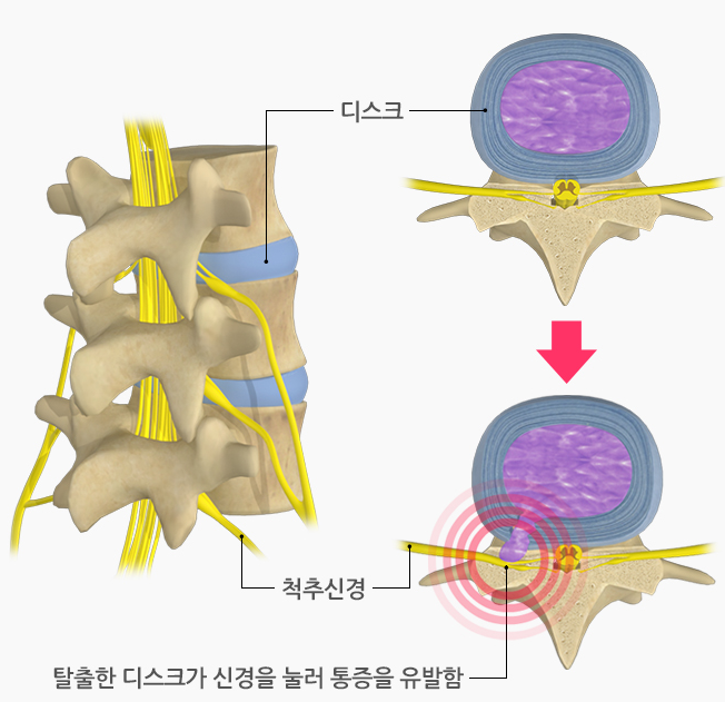 [손상] 요추&경추 추간판 탈출증
