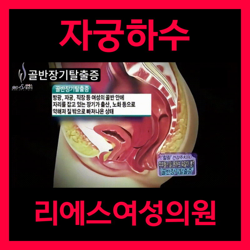 씻다가 깜짝! 질튀어나옴 증상, 당황말고 자궁하수부터 체크