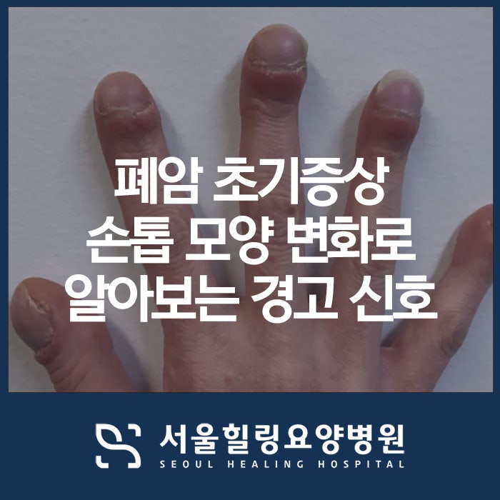 폐암 초기증상 손톱 모양 변화로 알아보는 내 몸의 경고 신호
