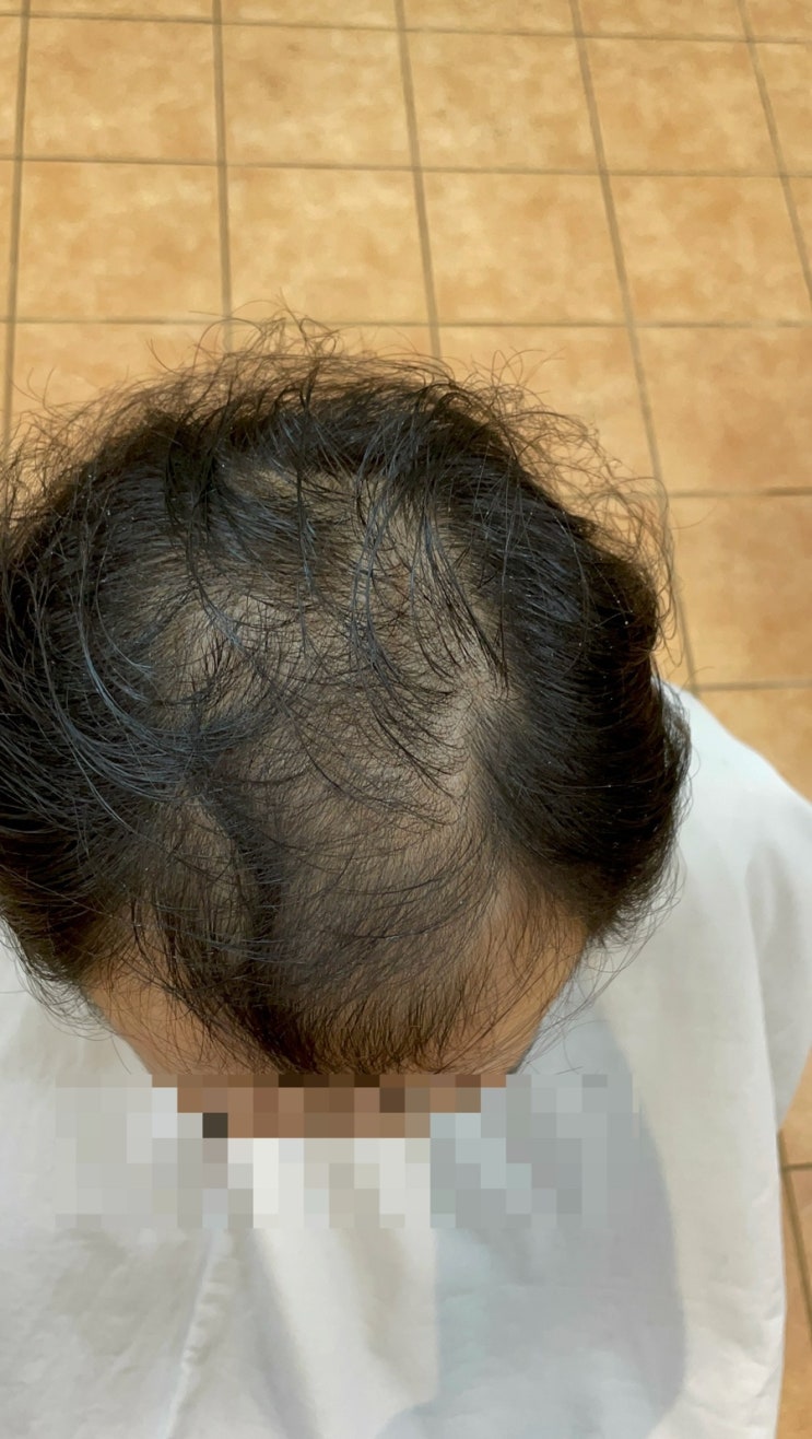  강원도에서 왔다구요? 남자탈모펌 하러 부산까지 온 이유｜정수리·M자 탈모 교정의 진짜 해답/ 사상감전주례학장김해대저화명하단다대초량남포중구부전문현전포대현광안동래사직온천해운대센텀광안