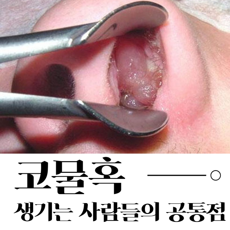  코물혹은 수술 말고 방법이 정말 없을까?
