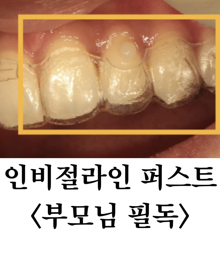  노원 인비절라인 퍼스트, 고민 중이라면? 체크해야 할 3가지 포인트