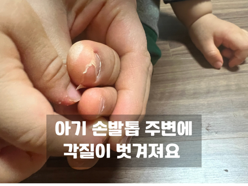 아기 손가락 발가락 살이 벗겨져요.