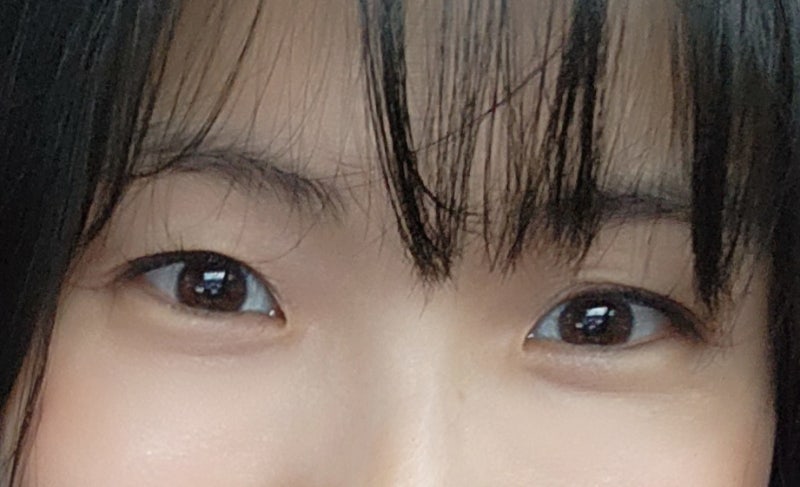 눈두덩이 지방이식 후기 / 눈두덩이 지방이식 전, 후 비교