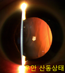  인공수정체 탈구 수술, 이렇게 대처하면 전보다 더 잘 볼 수 있습니다