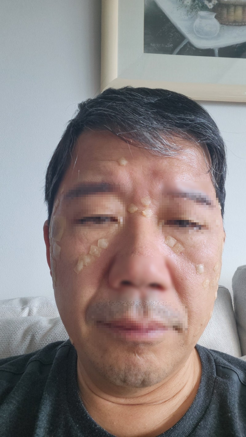 더힘찬한의원 해운대 레이저 시술 후기