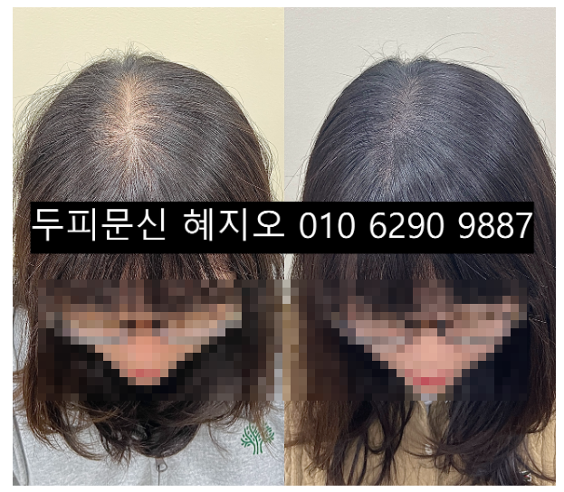  부천여자정수리탈모 두피페인팅 잘하는 곳 선택하는 기준 3가지