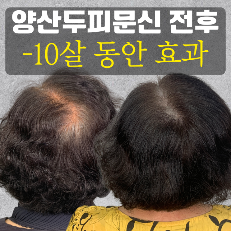  양산두피문신 50대 60대 여성 탈모, 휑한 정수리와 가르마 커버 솔직 후기