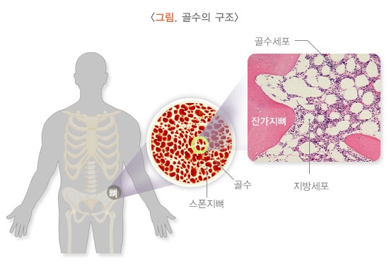 [건강정보] 골수검사