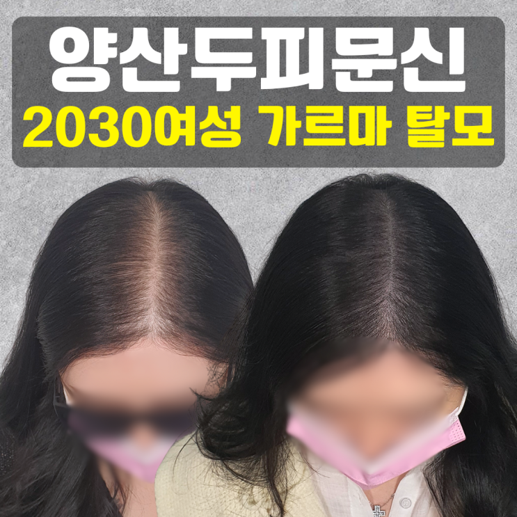  양산두피문신 20대 30대 여성, 넓어진 가르마 밀도보강 비용 & 유지기간