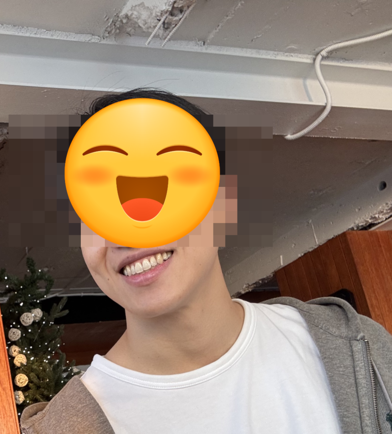 양악 수술 후기, 대학병원 선정부터 견적까지