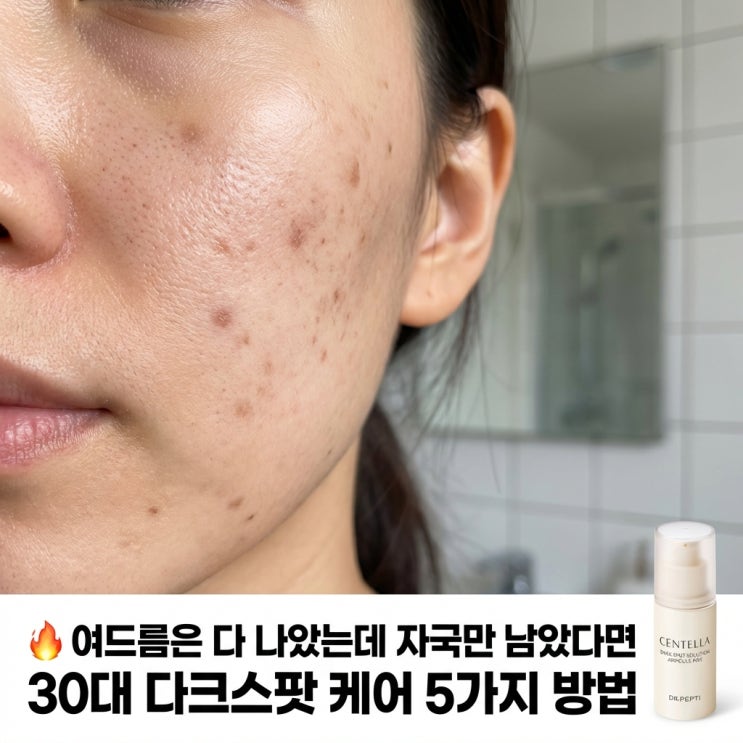   여드름은 다 나았는데 자국만 남았다면 | 30대 다크스팟 케어 5가지 방법