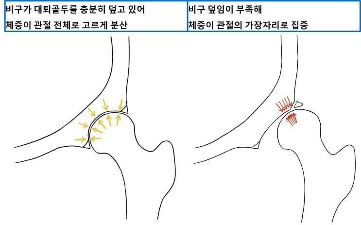  "엑스레이는 정상이라는데 왜 아플까요?" 놓치기 쉬운 고관절 이형성증