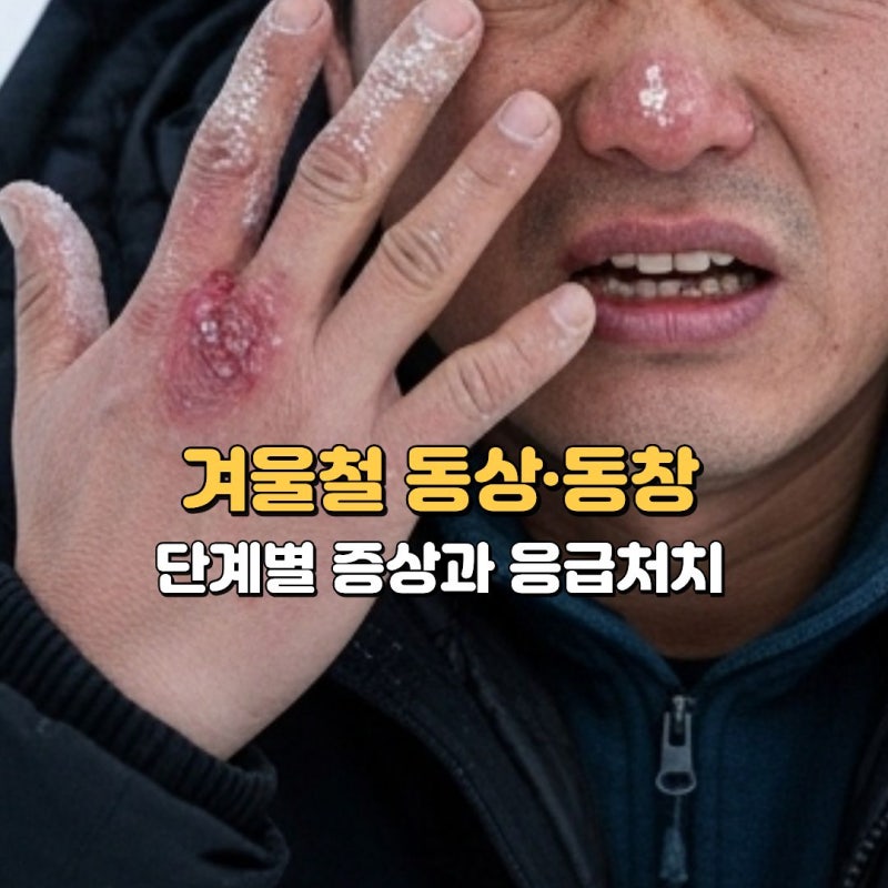 동상·동창 초기 증상과 응급처치, 발가락 손가락이 붉게 붓는 이유?