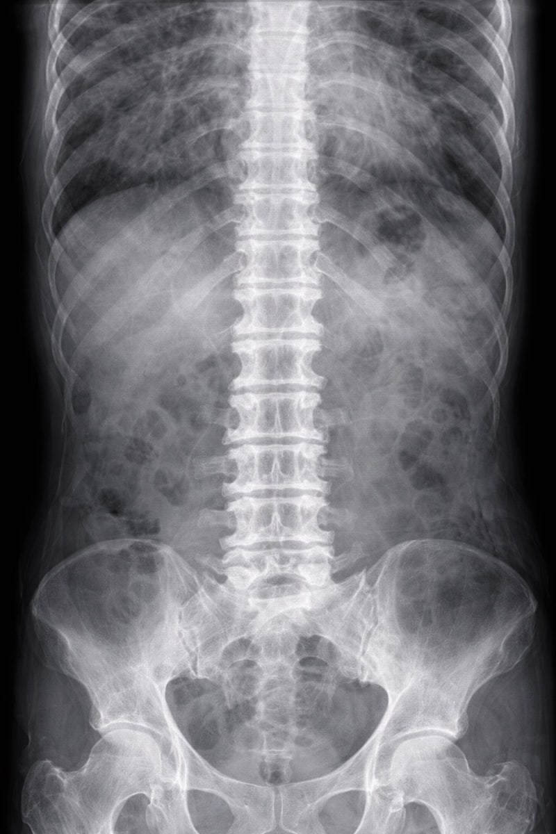 강직성척추염Ankylosing spondylitis이란? 원인과 증상, 주사와 약 같은 치료, 주의사항과 유전까지