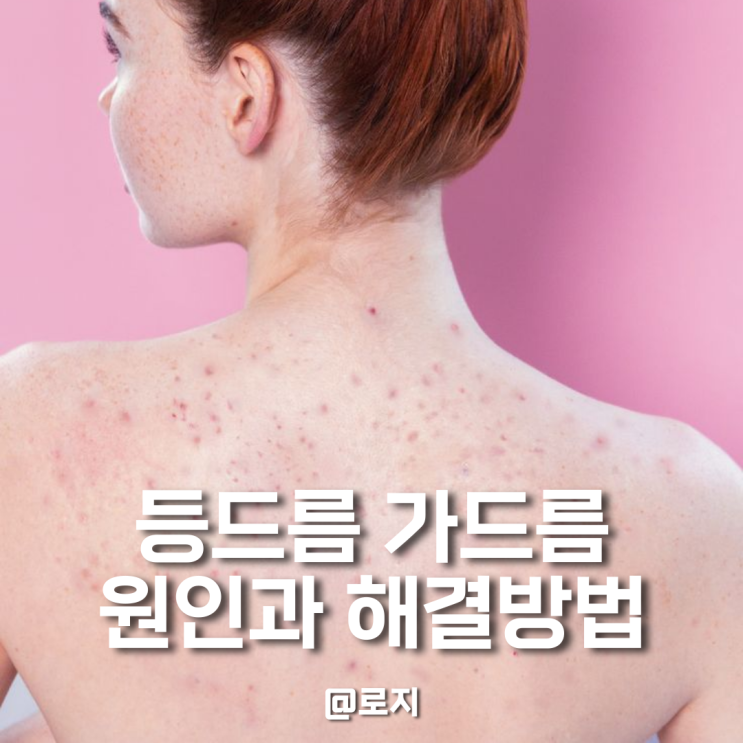  가드름, 등드름 없애는 법 원인과 해결방법