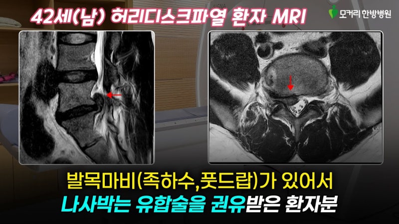 허리디스크파열, 족하수, 풋드랍(foot drop) 비수술 허리기능 재활치료 사례
