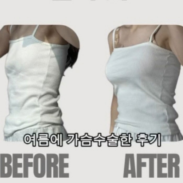 나는솔로 16기 순자 갑분 성형<b>수술</b>? 가슴<b>수술</b> & <b>쌍꺼풀 수술</b> 부작용, ....