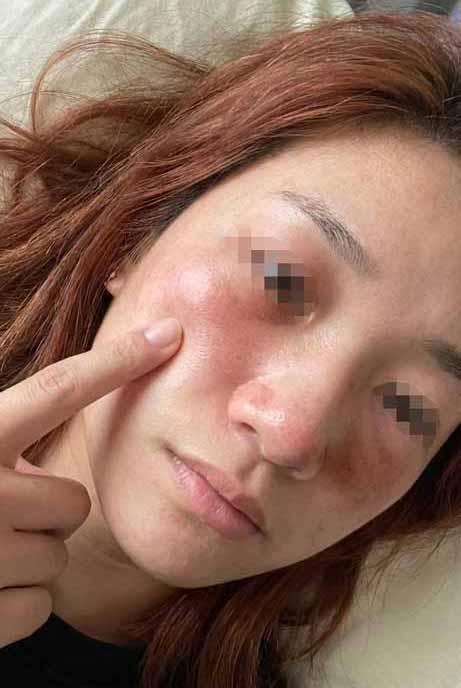  부비동염 증상 및 원인 치료, 수술 후 재발 항생제 없이 관리했던 후기