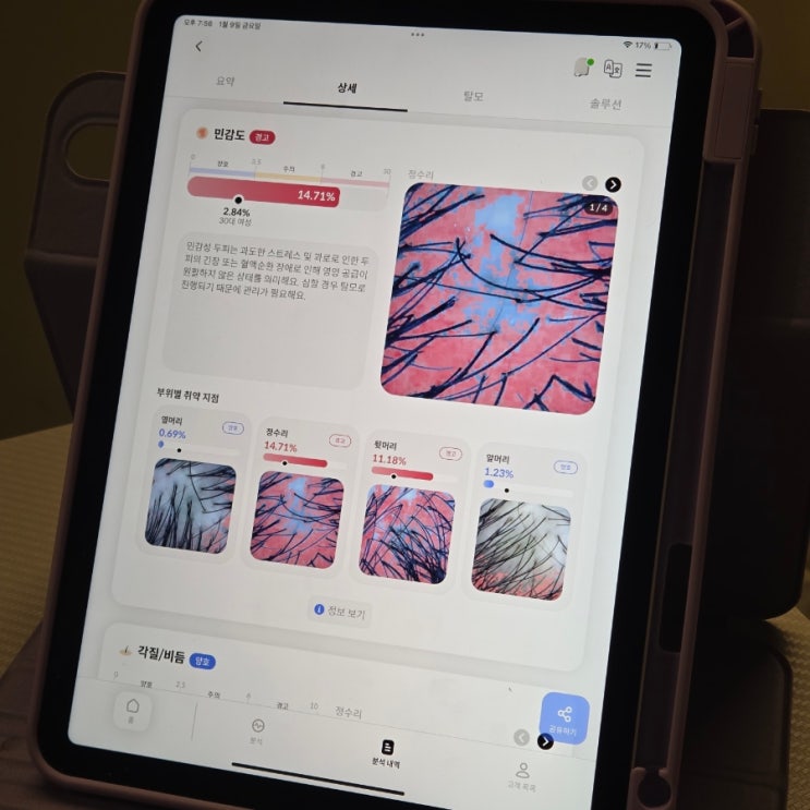  인천 구월동 두피관리 온무드 문제성 두피 집중케어받고 달라진 두피상태