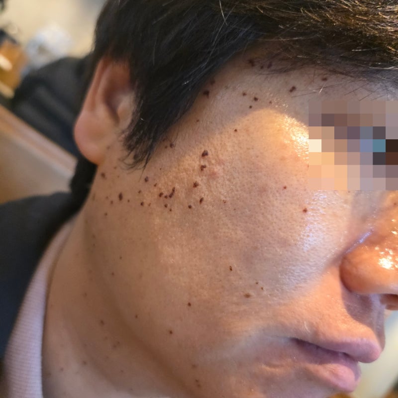 대구편평사마귀 대구쥐젖제거 대구한의원성지에서 무제한제거 찐 후기