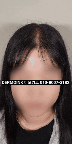  강남구청역 탈모 커버, 자연스러운 여자 가르마 밀도 보강 후기