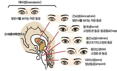 전신성 간성 뇌증(Hepatic encephalopathy)