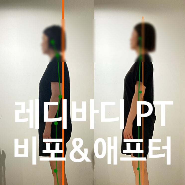  탄현 PT 허리·고관절 통증 탈출! 익상견갑 교정까지 확실하게