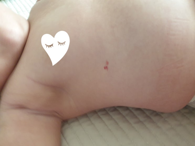  우리 아기에게 혈관종이 생겼어요! 어떻게 해야 할지 소아과에 다녀왔습니다.