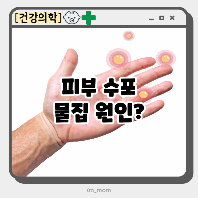 손등 손가락 수포 대상포진? 피부 수포 물집 원인